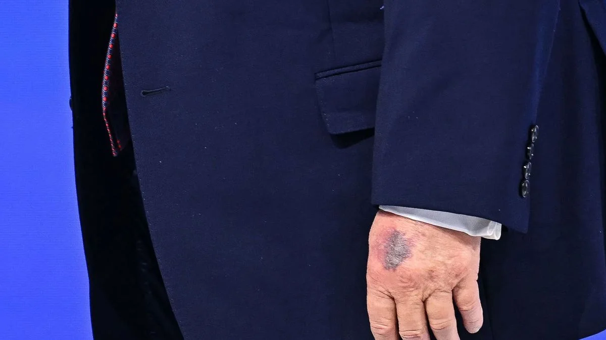Trump aparece en Davos con un morado gigante en su mano y genera preocupación