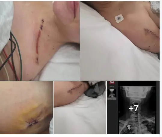 Nadia Beller muestra las heridas que dejó el atentado